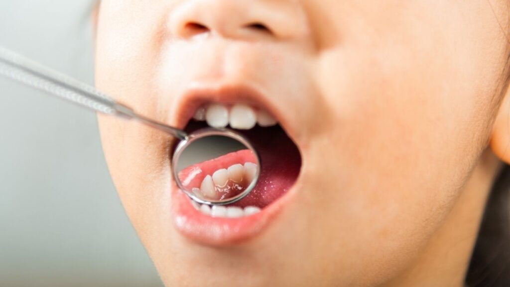 Un dentista examina la boca de un niño usando un espejo bucal, enfocándose en un molar sano.