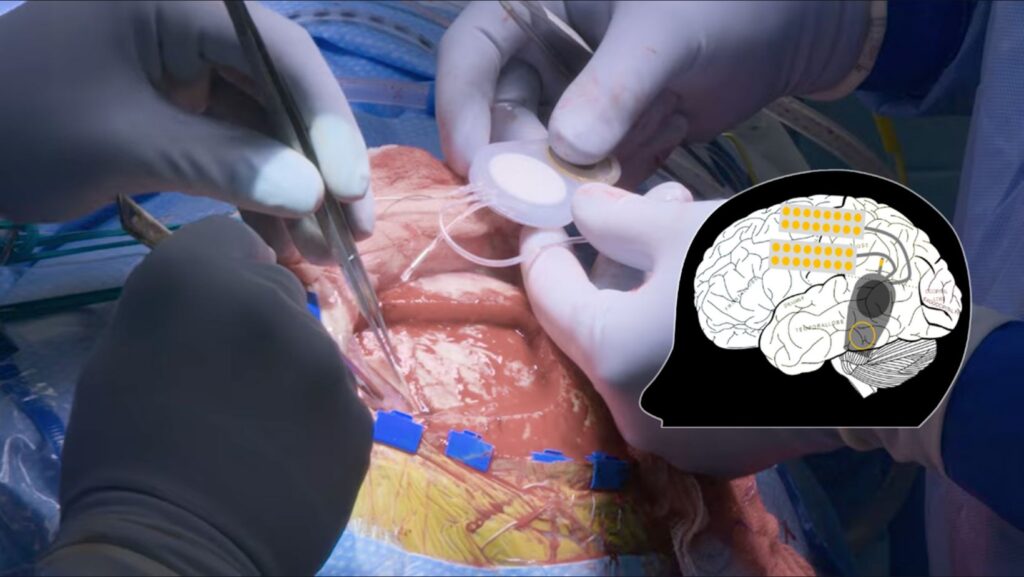 Equipo quirúrgico de UW Medicine implanta un dispositivo experimental de estimulación cortical en el cerebro de Matt Kidd durante un estudio clínico de recuperación motora tras un derrame cerebral. Material propiedad de UW Medicine.