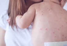 Confirmado brote de sarampión en el condado Snohomish con tres niños contagiados