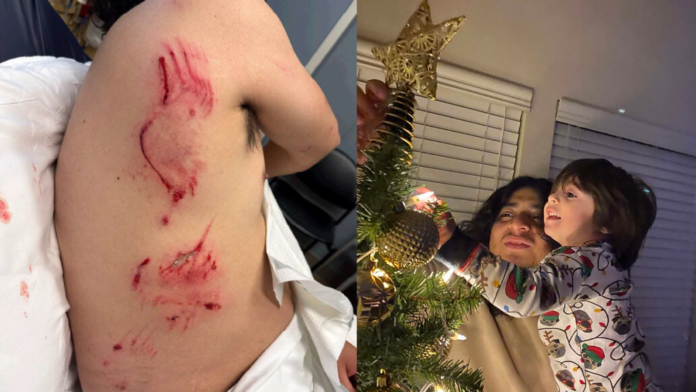 A la izquierda algunas de las lesiones sufridas por Wilmer Toledo Martínez tras el ataque de un perro de ICE durante su detención y a la derecha se observa a Wilmer Toledo-Martínez con uno de sus hijos colocando la estrella en el árbol de navidad - Cortesía de la senadora Patty Murray