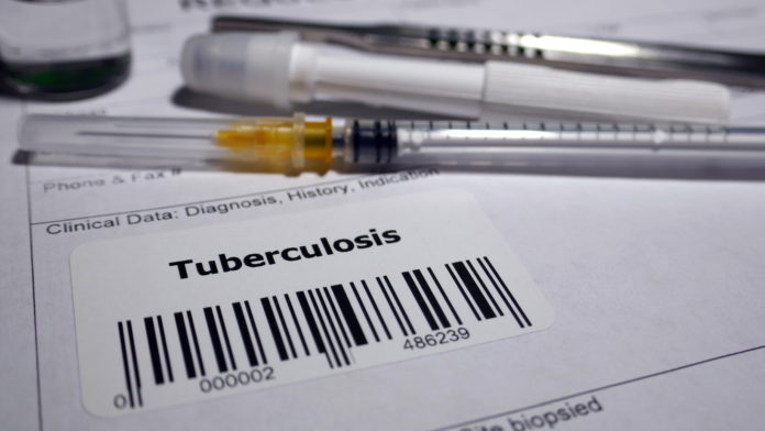 Prueba de tuberculosis