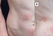 Condado King advierte sobre la propagación de una nueva infección de transmisión sexual Evaluación dermatológica de un paciente con erupción cutánea por Trichophyton mentagrophytes genotipo VII, que muestra tiña corporal (A y B), tiña genital — Foto: CDC