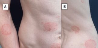 Condado King advierte sobre la propagación de una nueva infección de transmisión sexual Evaluación dermatológica de un paciente con erupción cutánea por Trichophyton mentagrophytes genotipo VII, que muestra tiña corporal (A y B), tiña genital — Foto: CDC