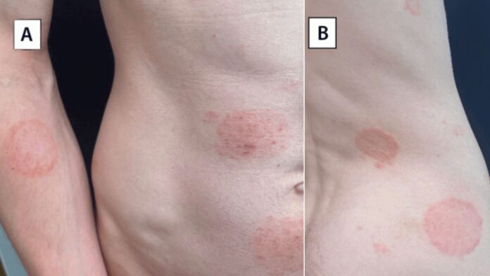 Evaluación dermatológica de un paciente con erupción cutánea por Trichophyton mentagrophytes genotipo VII, que muestra tiña corporal (A y B), tiña genital — Foto: CDC