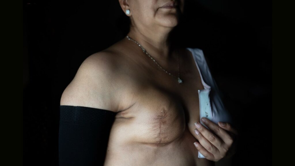 NOTA DEL EDITOR: DESNUDEZ - Cindy Banda muestra la cicatriz de su mastectomía, el 16 de septiembre de 2026, en su casa en McAllen, Texas. (Foto AP/Julia Demaree Nikhinson)